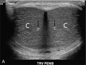 FIGURE 12-1, (A) Transverse and (B) longitudinal ultrasound images of a normal penis. The corpora cavernosa (C) have uniform echogenicity throughout. The echogenic tunica (open arrow) and echogenic walls of the cavernosal artery (arrows) are easily identified.