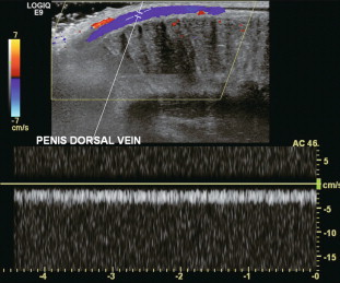 FIGURE 12-3, Colour and spectral Doppler tracing of the normal dorsal penile vein. Note the uniform relatively slow velocity.