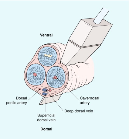 FIGURE 12-4, Ultrasound technique. A linear transducer is placed in a longitudinal plane along the ventral surface of the penis. Since the cavernosal arteries run parallel to the transducer, electronic steering of the Doppler beam is necessary to interrogate flow at an appropriate angle.