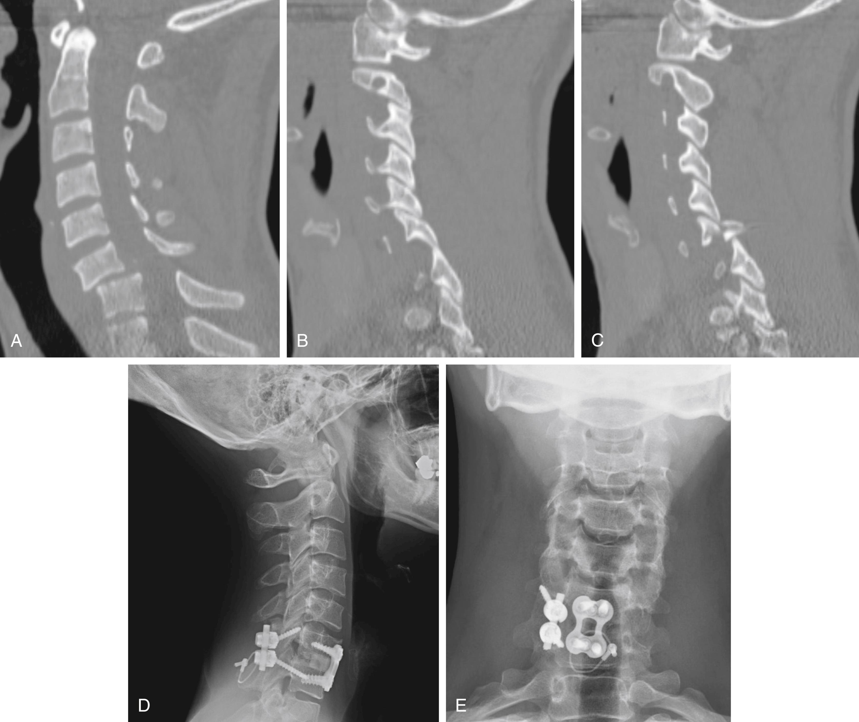 Fig. 107.1, Acute fracture dislocation at the C6–C7 level with perched facets and unilateral facet fracture ( A–C ). Anterior-posterior stabilization with C6-7 anterior cervical discectomy and fusion and posterior C6-7 lateral mass screw fixation ( D and E ).