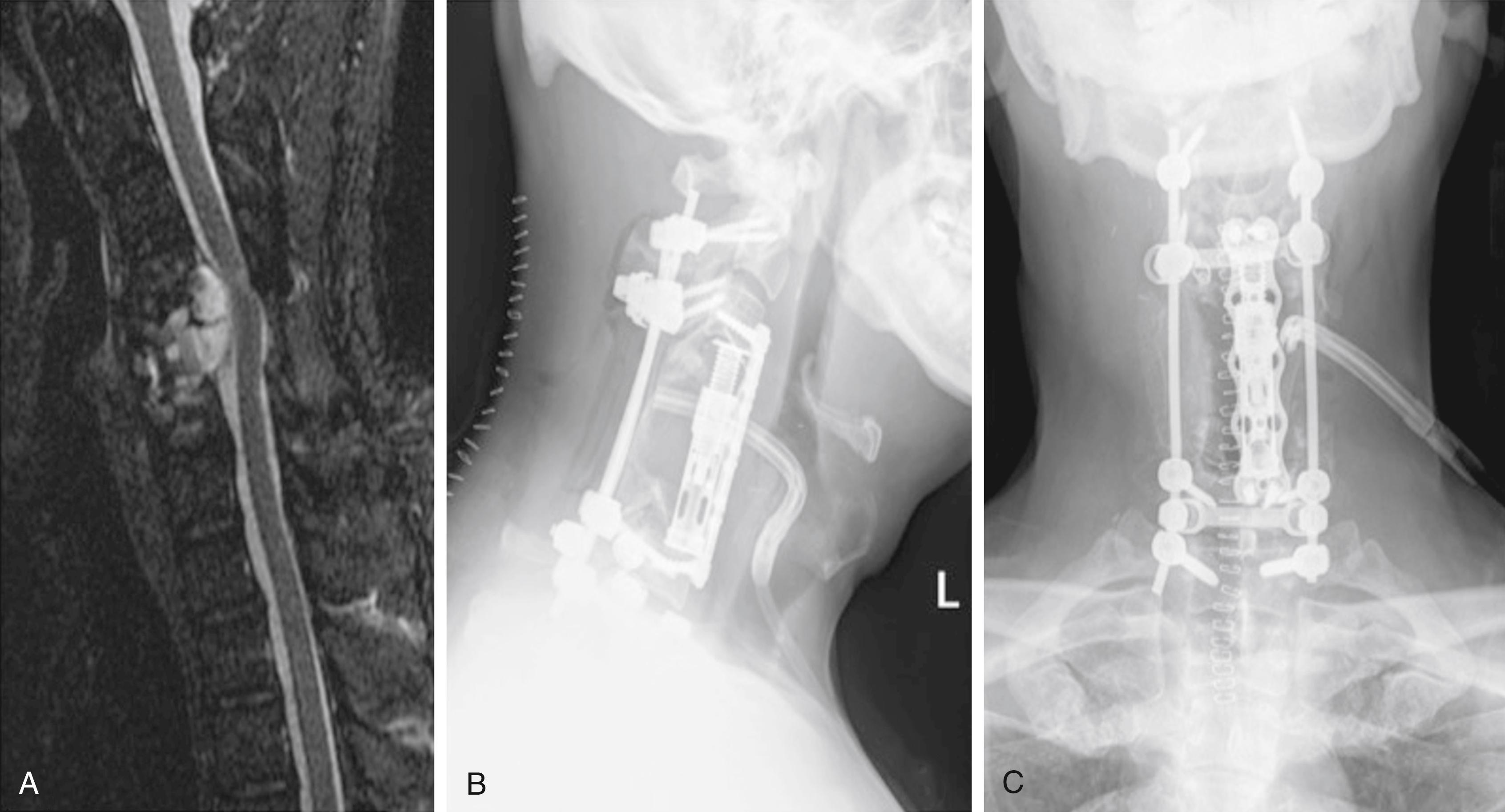 Fig. 107.2, Chordoma involving the vertebral bodies of C4–C6 ( A ). Multilevel corpectomies C4–C6 with posterior stabilization, including subaxial dorsal instrumentation ( B and C ).