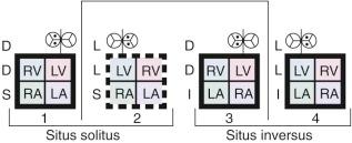 Figure 54-1, Models of the four basic hearts as they occur in double outlet left ventricle, depicting usual positions of great arteries (aorta medial to pulmonary trunk). Models 2 and 3 depict atrioventricular discordant connection. In the Van Praagh convention, first letter (S or I) refers to atrial position (solitus or inversus), second letter (D or L) to ventricular loop (right or left), and third letter to position of origin of aorta relative to origin of pulmonary trunk (see Appendix 1H in Chapter 1 ). Key: LA, Left atrium; LV, left ventricle; RA, right atrium; RV, right ventricle.