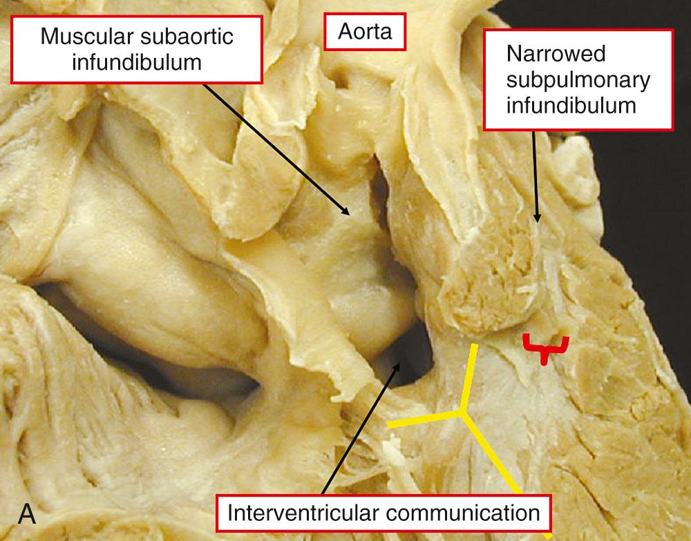 Fig. 39.3, Double-outlet right ventricle with subaortic interventricular communication and pulmonary stenosis. In both hearts, there is obstruction at the mouth of the subpulmonary infundibulum (bracket) . The heart in panel A has bilateral infundibula, whereas the heart in panel B has fibrous continuity in the roof of the defect between the leaflets of the aortic and mitral valves. In both hearts there is fibrous continuity posteroinferiorly between the leaflets of the mitral and tricuspid valves, making the defect perimembranous. As shown in panel A, the defect opens to the right ventricle between the limbs of the septomarginal trabeculation (yellow bars) .