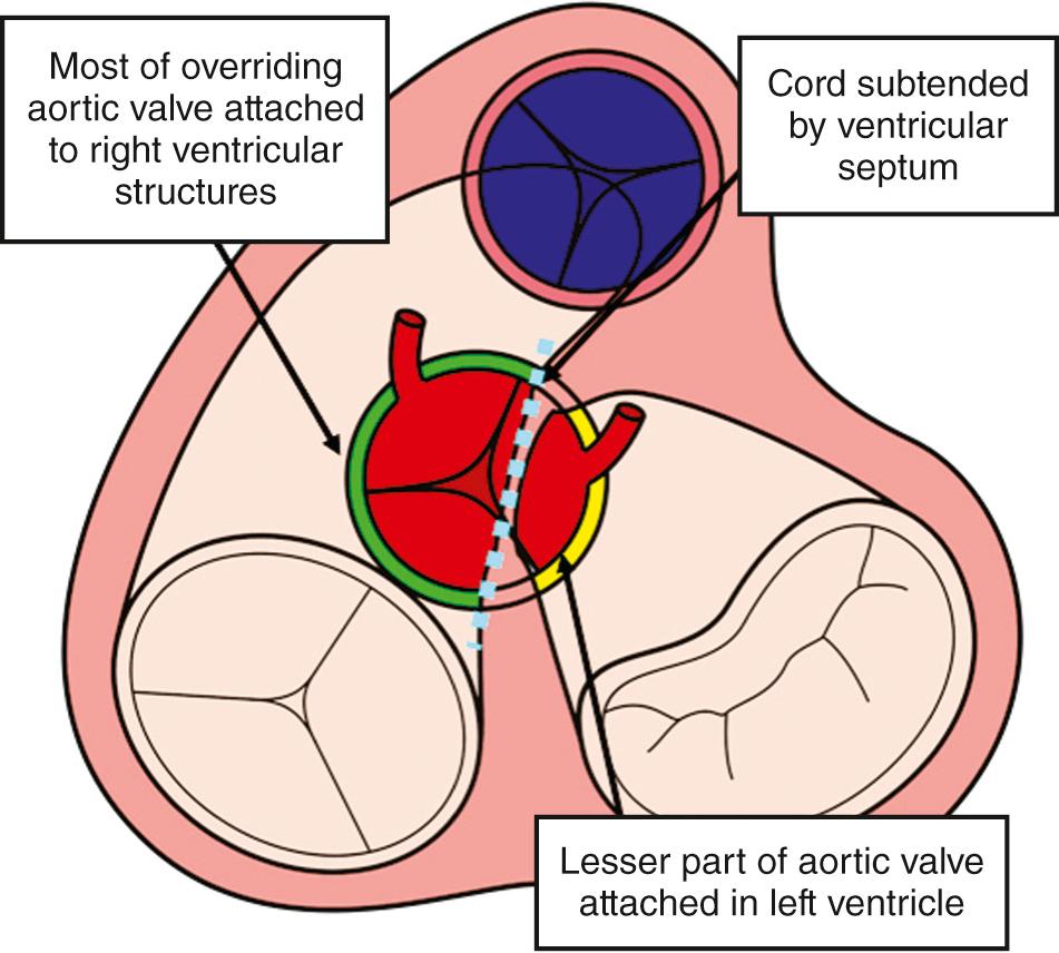 Fig. 39.4, Short axis of the base of the ventricular mass as viewed from the cardiac apex in the setting of overriding of the aortic root. When, as shown, the larger part of the circumference of the root (in green), is supported by the right ventricle when assessed relative to the chord subtended by the ventricular septum, the ventriculoarterial connection is justifiably considered to be diagnosed as double-outlet right ventricle. It follows that it is the lesser part of the circumference (in yellow) that is supported by the left ventricle.