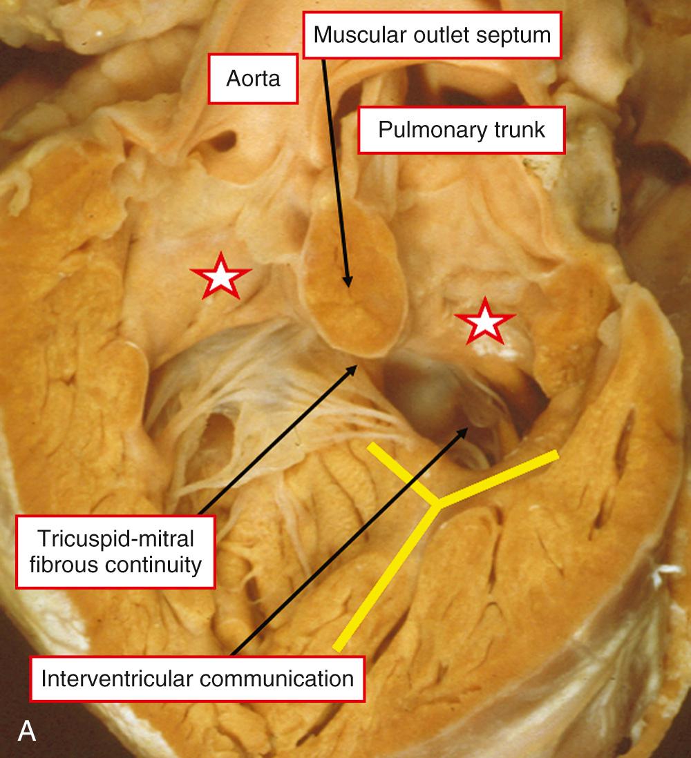 Fig. 39.5, Examples of the Taussig-Bing malformation, in which the interventricular communication is subpulmonary. In both hearts the defect opens to the right ventricle between the limbs of the septomarginal trabeculation (yellow bars) . The heart in panel A has bilateral infundibula (stars) , whereas in panel B there is only a subaortic infundibulum, with the roof of the defect formed by fibrous continuity between the leaflets of the mitral and pulmonary valves. In panel A the defect is perimembranous, whereas in panel B there is a muscular posteroinferior rim.