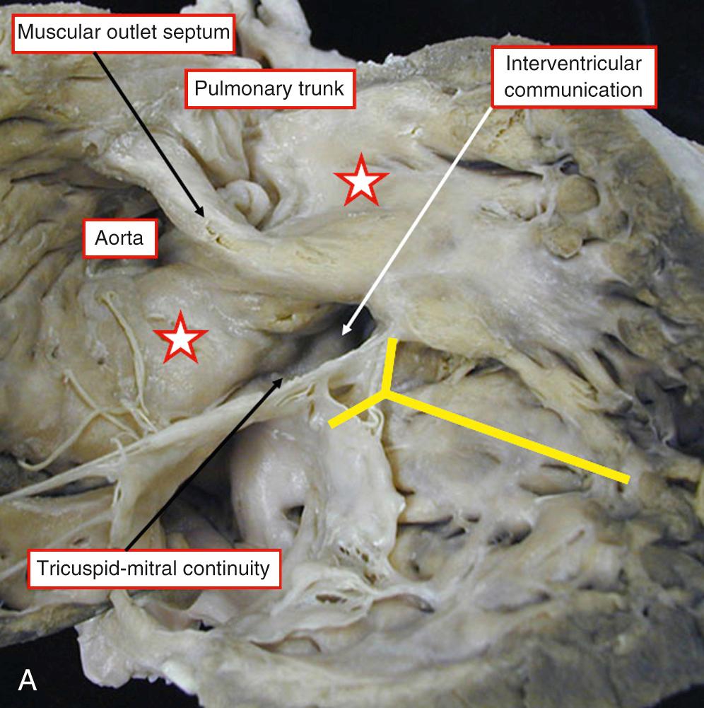 Fig. 39.6, Features of double-outlet right ventricle with subaortic interventricular communication in the presence of an unrestrictive pulmonary outflow tract. (A) Bilateral infundibula are present (stars) , but the defect remains perimembranous because of fibrous continuity between the leaflets of the mitral and tricuspid valves. (B) Mitral-to-aortic fibrous continuity is present in the roof of the defect, but the defect, which opens to the right ventricle between the limbs of the septomarginal trabeculation (yellow bars) , has a muscular posteroinferior rim (star) . The muscular rim protects the atrioventricular conduction axis.