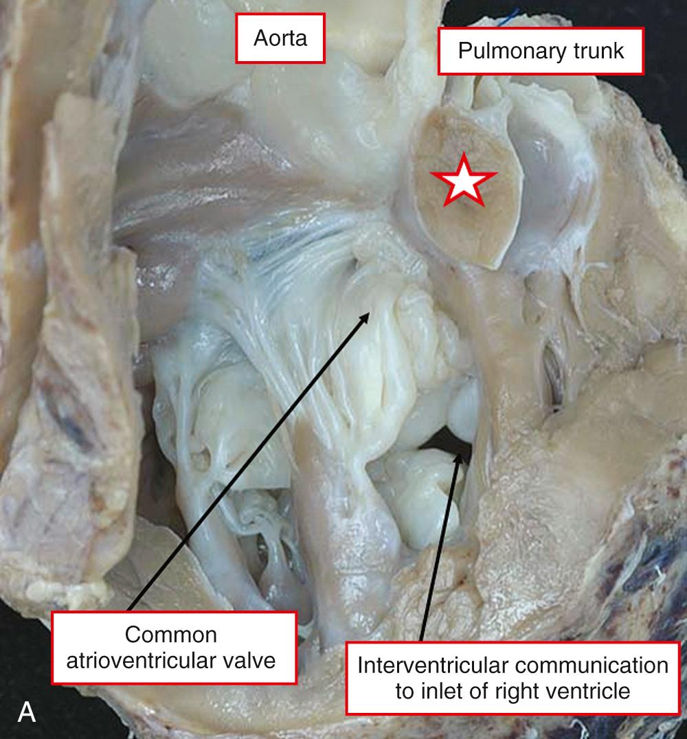 Fig. 39.7, Examples of anatomically noncommitted interventricular communications in the setting of double-outlet right ventricle. (A) This heart has an atrioventricular septal defect with common atrioventricular junction. In hearts of this kind, however, the surgeon may be able to create a tunnel to the subpulmonary outflow tract and achieve biventricular repair by also performing an arterial switch procedure. Note that the muscular outlet septum (star) has narrowed the subpulmonary outflow tract. (B) In this heart there is bilateral infundibula (stars) , and the defect is muscular and opens to the apical part of the ventricle. In this example, the location of the tricuspid valve means that the defect is noncommitted in both anatomic and surgical terms.
