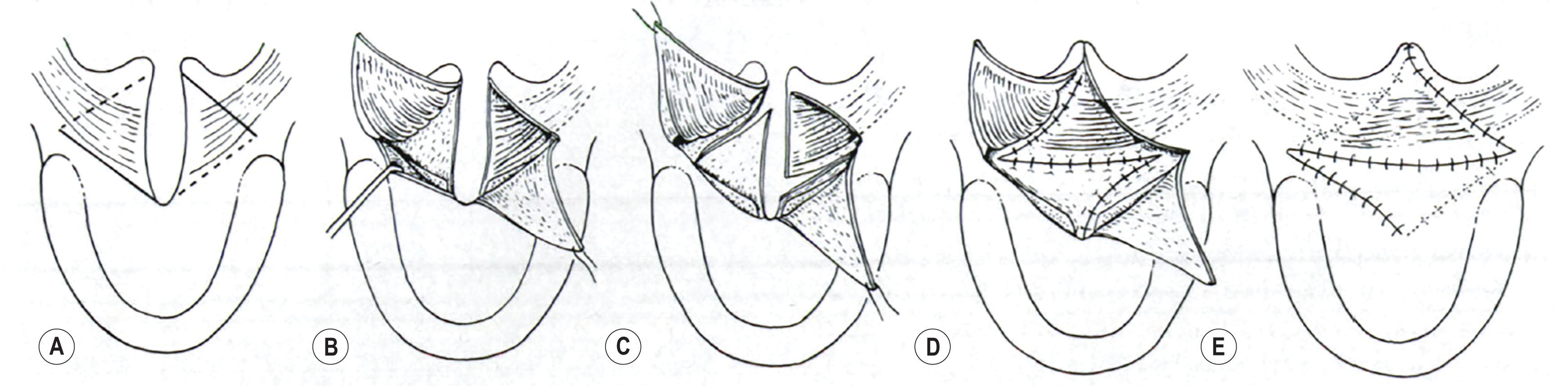 Figure 21.3.1, Dr. Leonard Furlow’s illustration of the double opposing Z-palatoplasty. (A) Z-plasty markings are performed along the oral mucosa. (B) Oral myomucosa and contralateral oral mucosa flaps are elevated. (C) Opposing nasal mucosa and nasal myomucosa flaps are then elevated. (D) Closure is performed along the nasal mucosa Z-plasty incisions. (E) The oral mucosa Z-plasty incisions are then closed.