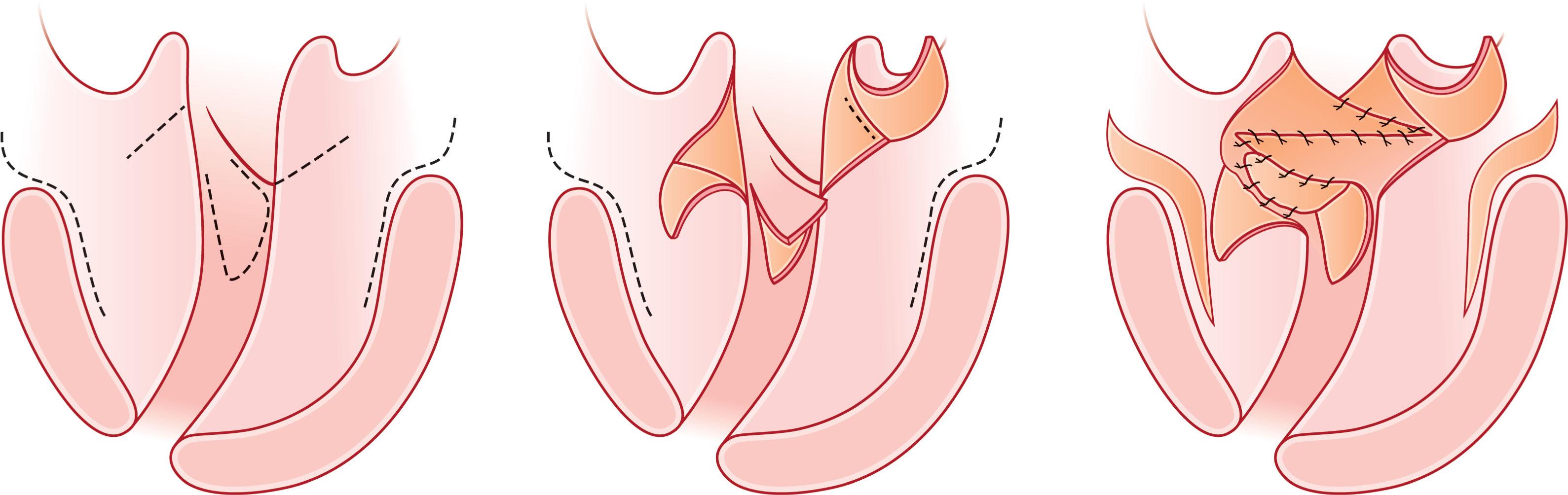 Figure 21.3.2, Peter Randall’s modification of the Furlow Z-palatoplasty using lateral relaxing incisions and a vomer flap to assist with closure of the nasal mucosa.