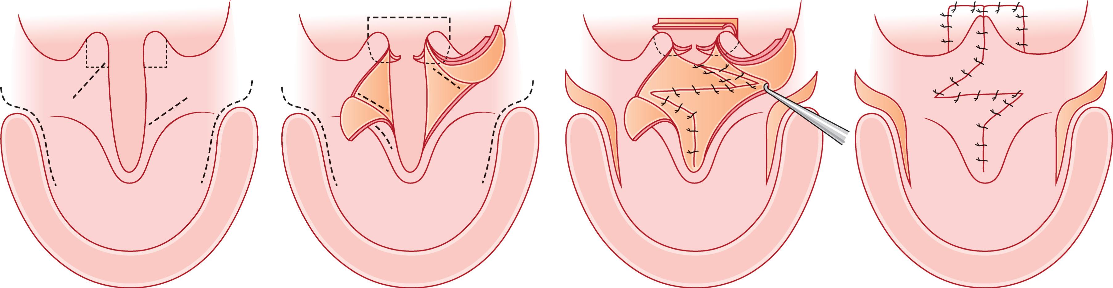 Figure 21.3.3, Peter Randall’s modification of the Furlow Z-palatoplasty incorporating a posterior pharyngeal flap at the time of primary repair in cases where the palate was deemed to be of inadequate length.