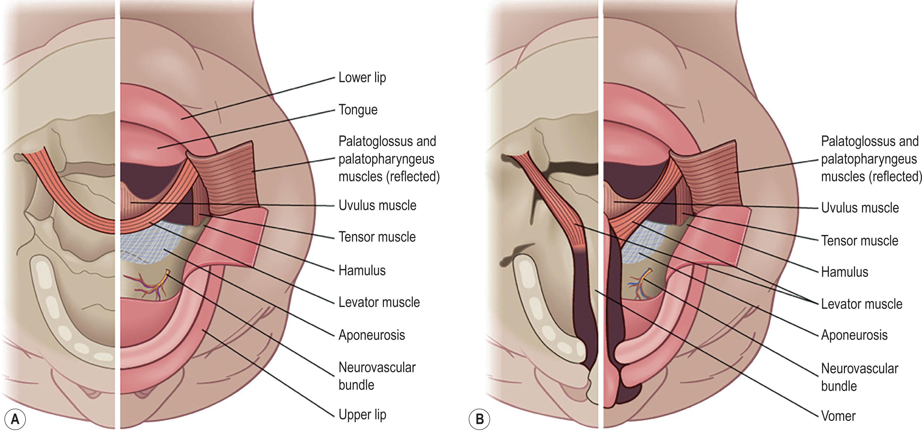 Figure 21.3.4, Palatal anatomy in (A) a normal patient, (B) in a patient with cleft palate.