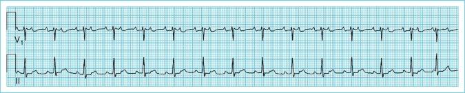 Figure 9.2, Atrial tachycardia with atrioventricular block.