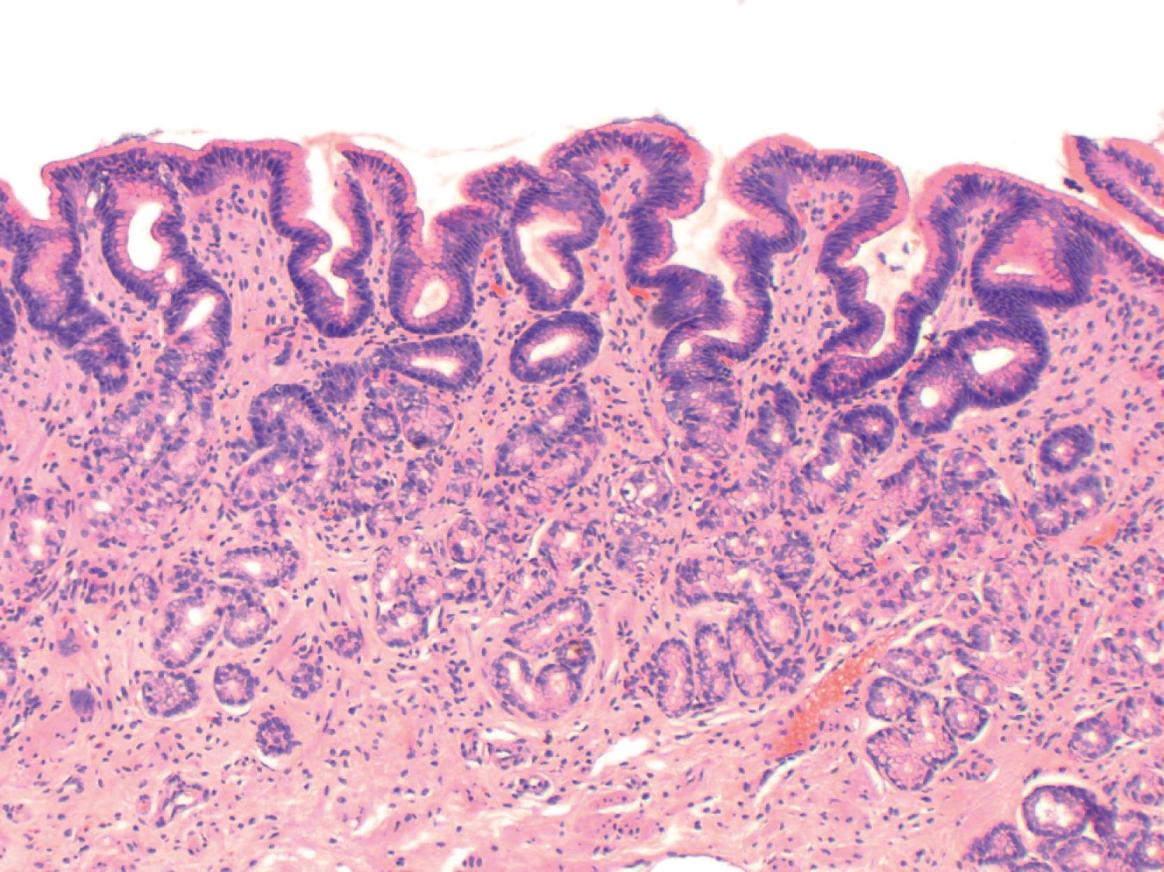 FIGURE 12.2, Chemical gastritis. The antral mucosa shows damage to the foveolar cells characterized by mucin diminution, basophilia, and elongation of the pits, which have an irregular contour. The lamina propria shows mild fibrosis but little inflammation.