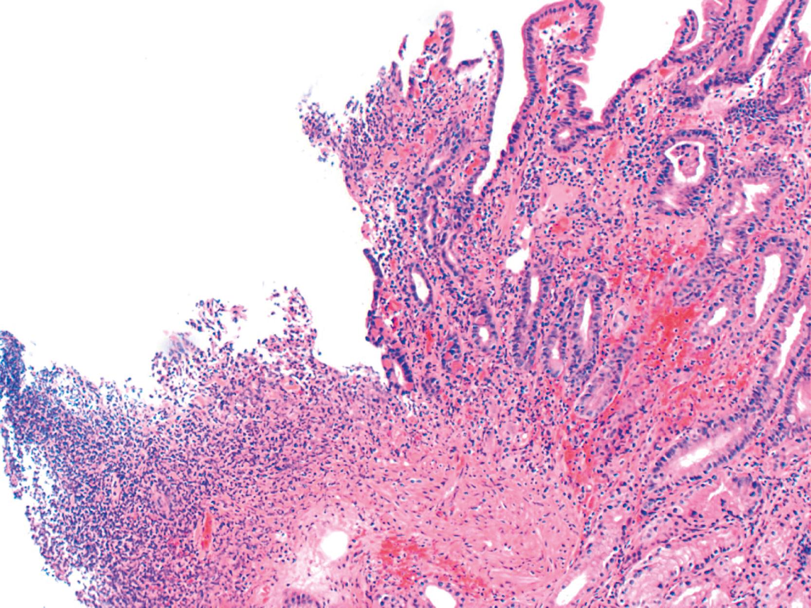 FIGURE 12.5, Duodenal ulcer with fibrinopurulent exudate (left) and mucosal inflammation and hemorrhage (right) in a patient who attempted suicide by ingesting acetaminophen.