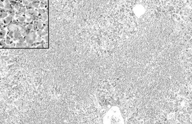 Fig. 56-5, Submassive (zone 3) coagulative necrosis attributable to an overdose of acetaminophen. Viable hepatocytes surround the portal areas, and the terminal hepatic venules are surrounded by necrotic tissue. The inset shows the necrotic hepatocytes at high magnification.