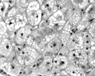 Fig. 56-9, Microvesicular steatosis in a child taking valproic acid. Most of the hepatocytes have small vacuoles of fat, and liver cell dropout with Kupffer cell hypertrophy and a mild lymphocytic infiltrate are visible.