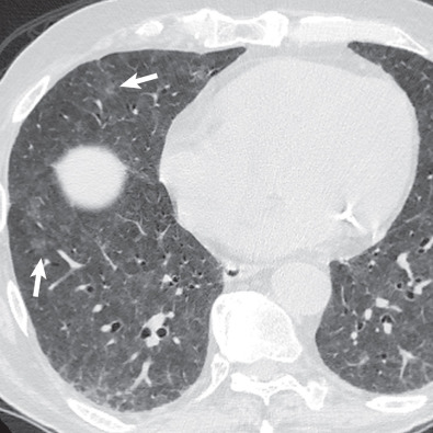 Fig. 65.1, Drug-induced lung injury resulting in a combination of nonspecific interstitial pneumonia and hypersensitivity pneumonitis patterns caused by lenalidomide and bortezomib therapy in a patient with relapsed multiple myeloma. Axial CT at the lung bases demonstrates bilateral ground-glass opacities, tiny (<5 mm) centrilobular ground-glass nodules (arrows), and peripheral reticulation and architectural distortion. Cessation of the drugs resulted in marked clinical improvement with resolution of dyspnea.