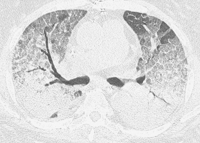 Fig. 65.2, Diffuse alveolar damage caused by amiodarone. Axial CT demonstrates extensive bilateral ground-glass opacities and dependent areas of consolidation. Note focal lobular areas of sparing and smooth lines superimposed on the ground-glass opacities, resulting in a crazy paving pattern. The patient presented with progressive shortness of breath and developed respiratory failure.