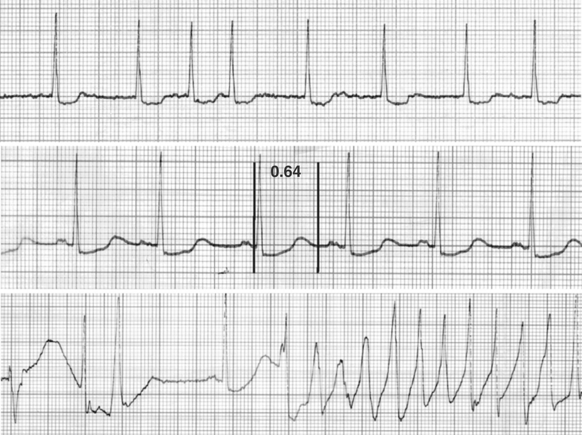 Fig. 102.1, Electrocardiogram recordings from a patient recently started on sotalol.