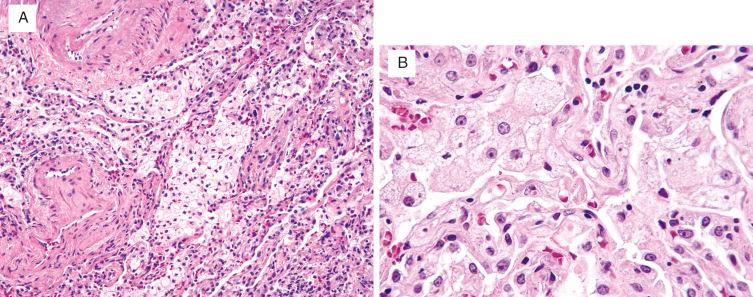 FIG. 19.1, Amiodarone pulmonary toxicity. (A) and (B) Foamy macrophages fill alveolar spaces, and minimal interstitial inflammation is present.