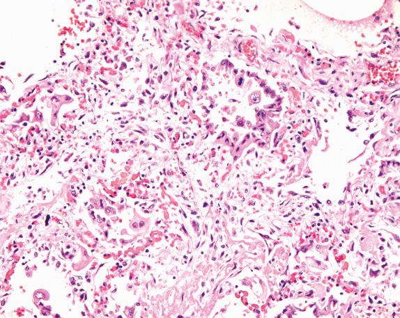 FIG. 19.2, Bleomycin pulmonary toxicity. Organizing diffuse alveolar damage with pneumocyte cytoatypia is observed.