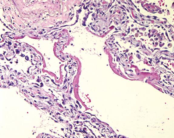 FIG. 19.3, Cyclophosphamide-associated lung injury. Conspicuous hyaline membranes indicate the presence of diffuse alveolar damage. Pneumocyte atypia is focal.