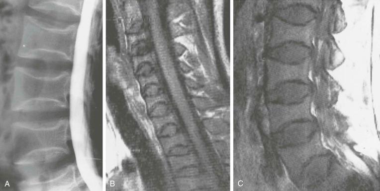 eFIGURE 89–1, Corticosteroid-induced osteoporosis. This 22-year-old woman had received systemic corticosteroid therapy for many months as a child. She subsequently developed cushingoid features. Lateral radiograph ( A ) obtained during a lumbar myelogram (performed for investigation of low back pain) reveals osteopenia, biconcave deformities of multiple vertebral bodies, and well-defined subchondral bone plates. Sagittal T1-weighted (TR/TE, 200/26) spin-echo MR images of the cervical spine ( B ) and lumbar spine ( C ) show the biconcave deformities to good advantage. The signal intensity of the bone marrow reflects the presence of hematopoietic tissue and is within normal limits.