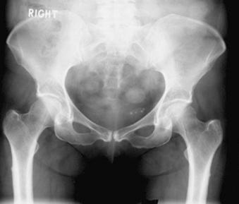 eFIGURE 89–12, Focal lateral cortical thickening was noted within the subtrochanteric region bilaterally.