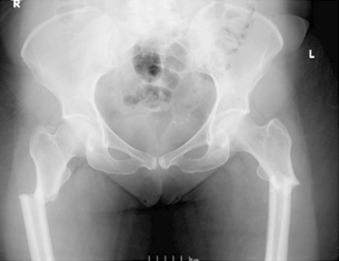 eFIGURE 89–13, Frontal radiograph revealed bilateral transverse subtrochanteric femoral fractures with medial beaking. Bilateral lateral femoral cortical thickening was noted.