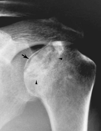 eFIGURE 89–2, Corticosteroid-induced osteonecrosis. Proximal end of the humerus. Abnormalities consist of flattening of the humeral head with a subchondral radiolucent line (crescent sign) (arrow) , surrounding osteolysis and osteosclerosis (arrowheads) , and relative preservation of joint space.