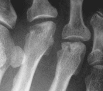 eFIGURE 89–4, Corticosteroid-induced osteonecrosis: metatarsal heads. Note sclerosis, radiolucent zones, and collapse of the second and third metatarsal heads.