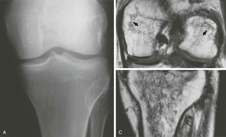 eFIGURE 89–5, Corticosteroid-induced osteonecrosis: distal end of the femur and proximal portion of the tibia. A , The routine radiograph is normal. B and C , Two coronal T1-weighted (TR/TE, 750/20) spin-echo MR images show characteristic findings of osteonecrosis involving both femoral condyles (arrows) and tibia.