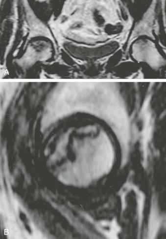 eFIGURE 89–6, Corticosteroid-induced osteonecrosis: femoral heads. This 62-year-old woman had received intraocular corticosteroids for glaucoma. Coronal ( A ) intermediate-weighted (TR/TE, 2000/30) and sagittal ( B ) T1-weighted (TR/TE, 600/12) spin-echo MR images reveal bilateral osteonecrosis of the femoral heads. The sagittal image in B is of the right femoral head. Note the serpentine regions of low signal intensity.