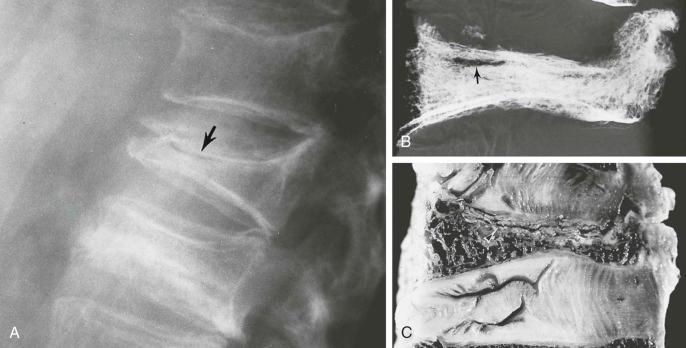 eFIGURE 89–7, Corticosteroid-induced osteonecrosis: vertebral bodies. A , Note the collapse of multiple osteoporotic lumbar vertebral bodies, reactive sclerosis of end plates, and a radiolucent line or crescent within the bone (arrow) . The last-mentioned finding differs from a vacuum intervertebral disk, in which the radiolucent collection is located in the disk itself. B and C , A radiograph and a photograph of a spinal section show a radiolucent collection (arrow) that corresponds in position to a fracture (arrowhead) in a collapsed vertebral body.