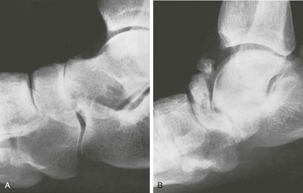 eFIGURE 89–8, Corticosteroid-induced neuropathic-like arthropathy. This patient with rheumatoid arthritis had had repeated injections of corticosteroids into the talonavicular space. Radiographs obtained 2 years apart indicate progressive abnormalities. The initial film ( A ) demonstrates joint space narrowing, sclerosis, and subchondral cyst formation, whereas the later film ( B ) reveals fragmentation of the talus and navicular bone. The findings are unlike those of uncomplicated rheumatoid arthritis and resemble neuropathic changes.