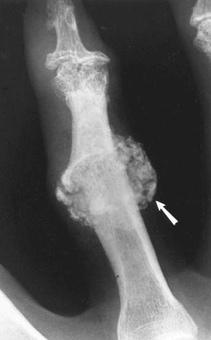 eFIGURE 89–10, Corticosteroid-induced intraarticular and periarticular calcification. In a 57-year-old woman with osteoarthritis of the interphalangeal joints of both hands, multiple intraarticular injections of triamcinolone hexacetonide were followed by the development of intraarticular and periarticular calcifications (arrow) , presumably related to calcium hydroxyapatite crystal deposition.