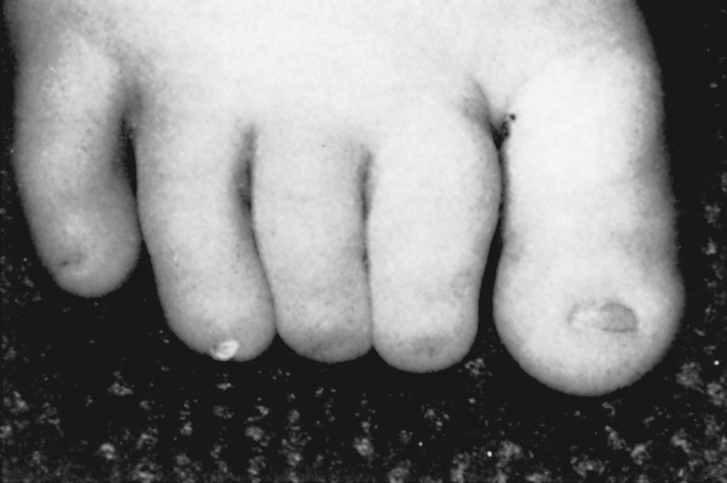 Fig. 7.5, Hypoplasia of the Toenails and Distal Phalanges.