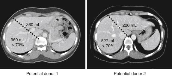 FIGURE 57-2, Two potential donors demonstrated a large right lobe (>70% of total liver volume) and small left lobe (<30%) on preoperative volumetric computed tomography.