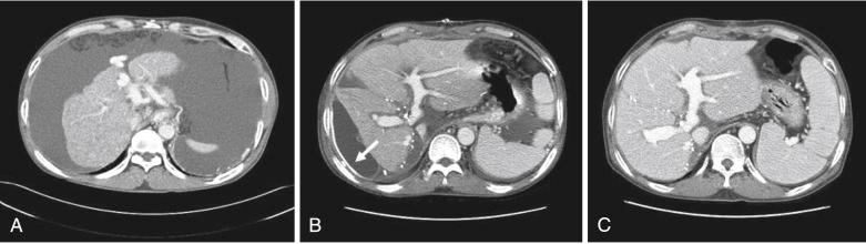 FIGURE 57-3, Regeneration of two left-lobe grafts in dual-graft liver transplantation.