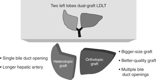 FIGURE 57-4, Which graft will be located in the orthotopic left-sided position? LDLT , Living donor liver transplantation.