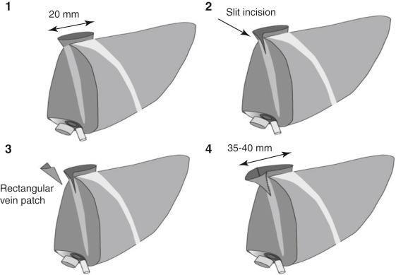 FIGURE 57-5, Augmentation hepatic venoplasty of left-lobe graft at the back table.