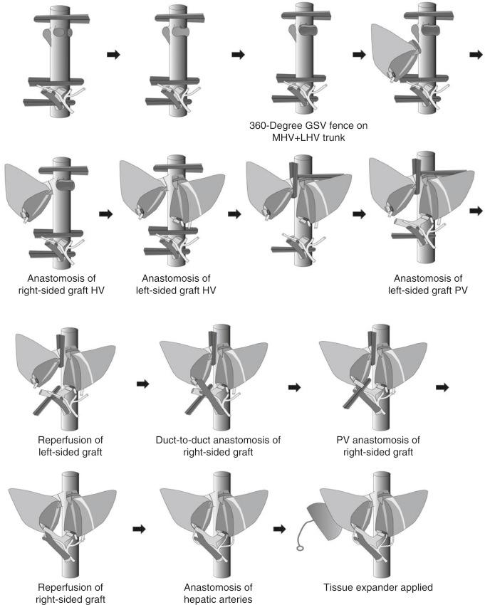 FIGURE 57-6, Anastomosis of dual-graft living donor liver transplantation using two left lobes. GSV , Great saphenous vein; HV , hepatic vein; LHV , left hepatic vein; MHV , middle hepatic vein; PV , portal vein.