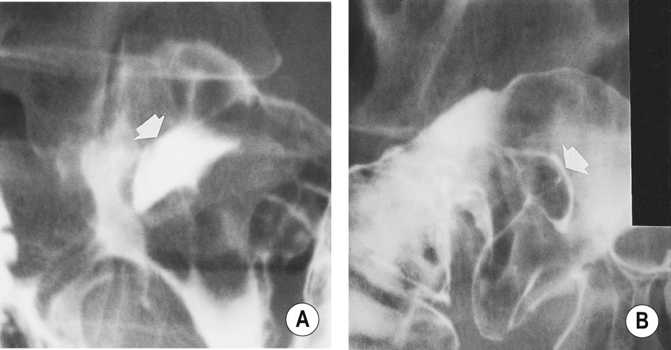 Anterior wall duodenal ulcer. (A) prone projection. The ulcer (arrow) is dependent, and so fills with barium. (B) supine projection. The ulcer, which is now on the non-dependent wall of the cap, is outlined with a ring of barium (arrow). †