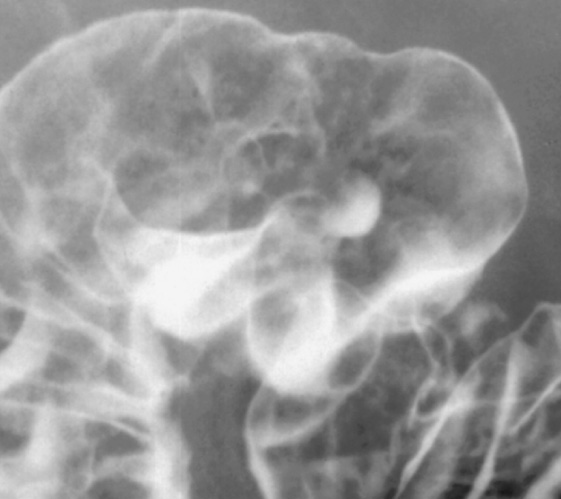 Duodenal ulcer. Barium collects in an ulcer on the dependent (posterior) wall of the duodenal cap. †