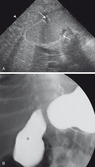 Figure 102.1, Duodenal stenosis.