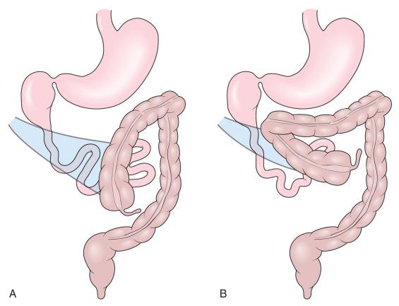 e-Figure 102.13, Ladd bands.