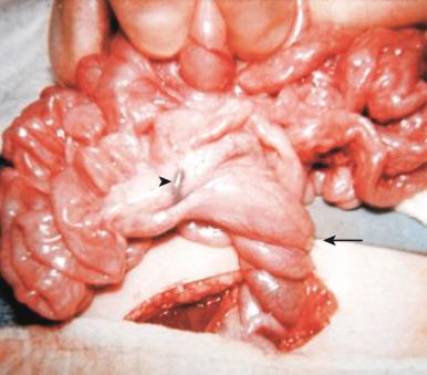 Figure 102.14, Acute midgut volvulus. At surgery, the duodenum is twisted clockwise (arrow) about the axis of the superior mesenteric artery (arrowhead) .