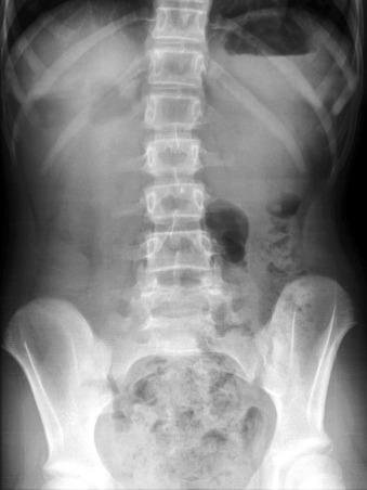 Figure 102.15, Nonrotation. Abdominal radiograph in an adolescent with nonrotation. Note that there is no evidence of colon in the right abdomen. The stool-filled colon is confined to the left side of the abdomen.