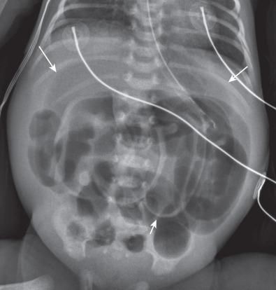 e-Figure 102.17, Midgut volvulus in a premature infant. The infant was tolerating increased feedings, when overnight he began having nonbilious residuals and had systemic symptoms consistent with sepsis. Radiograph shows generalized dilatation of bowel loops and free air (arrows) . At surgery, there was malrotation with midgut volvulus and bowel necrosis.