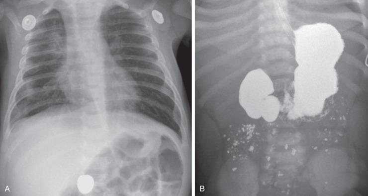 e-Figure 102.2, Duodenal stenosis with foreign body.